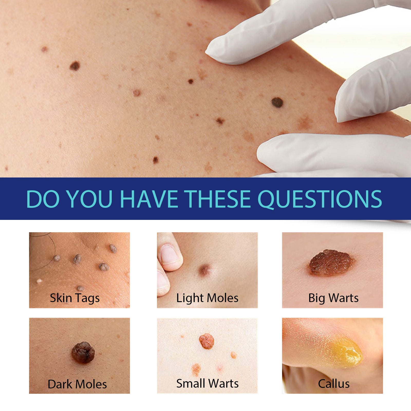 Clear Tag, Fade Out Skin Warts Moles Corns Filamentous Slow Optimal Hou Warts Smooth Skin Warts