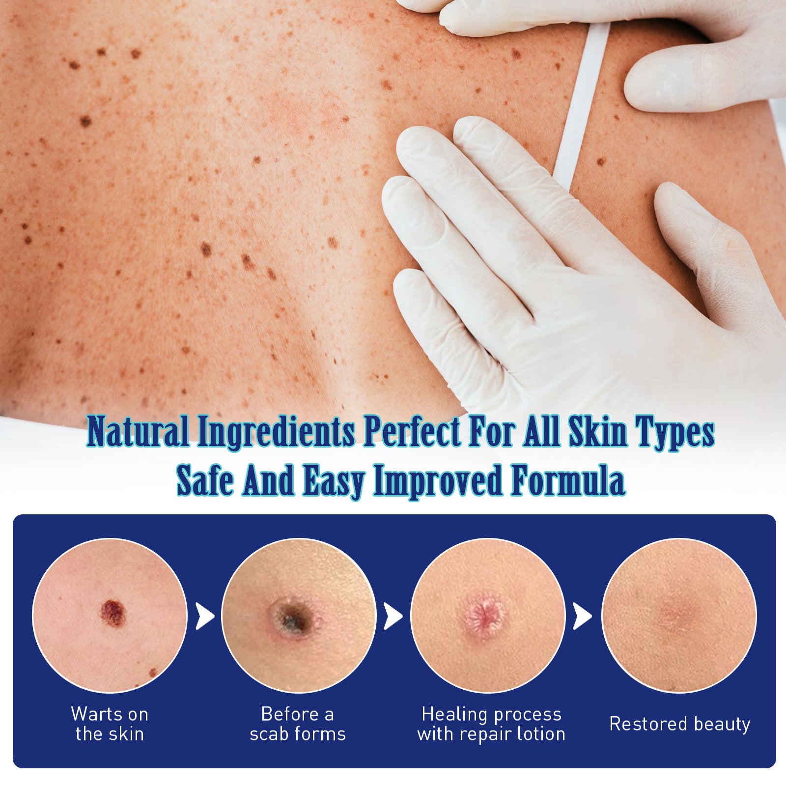 Clear Tag, Fade Out Skin Warts Moles Corns Filamentous Slow Optimal Hou Warts Smooth Skin Warts